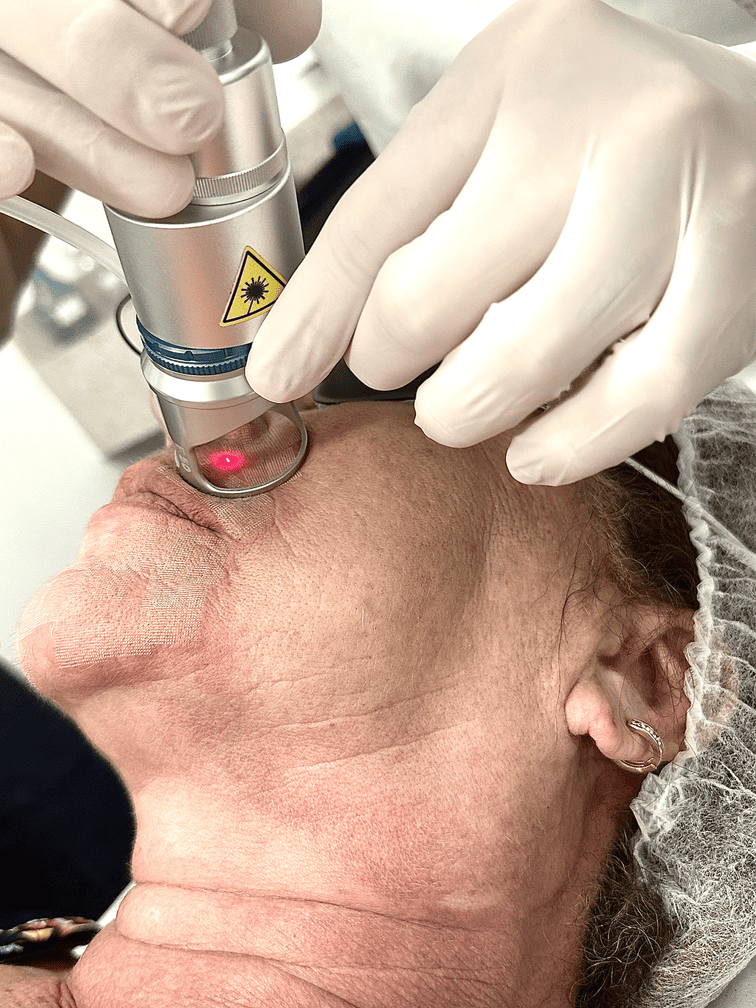 tratamento-laser-co2-1